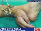 В Китае врачи спасли оторванную руку рабочего, пришив ее к ноге
