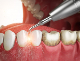 Профессиональная чистка зубов и ее преимущества