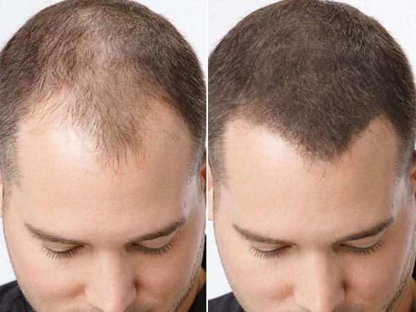 Как загустить волосы мужчине