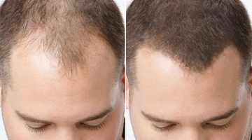 Как загустить волосы мужчине