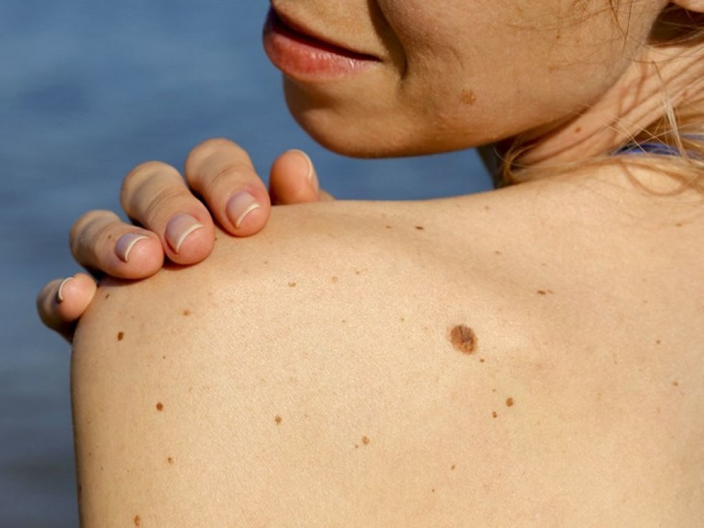 Меланома кожи: признаки, симптомы, причины и лечение