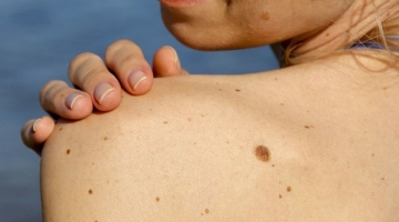 Меланома кожи: признаки, симптомы, причины и лечение