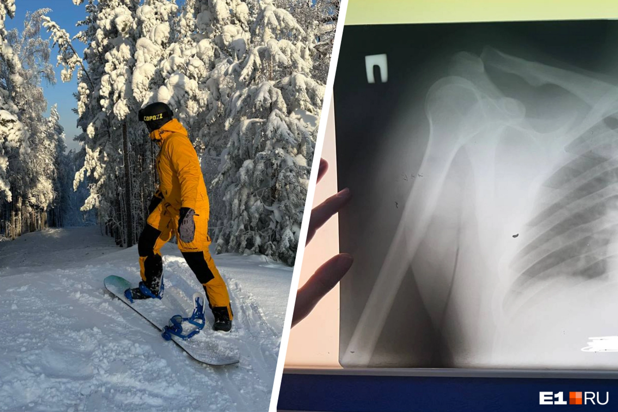 Во время отдыха на горе Пильная лыжнику разорвал плечо