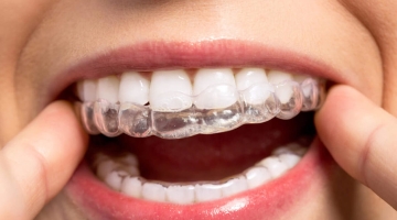 Выровняйте зубы с помощью элайнеров: быстро, эстетично, без брекетов