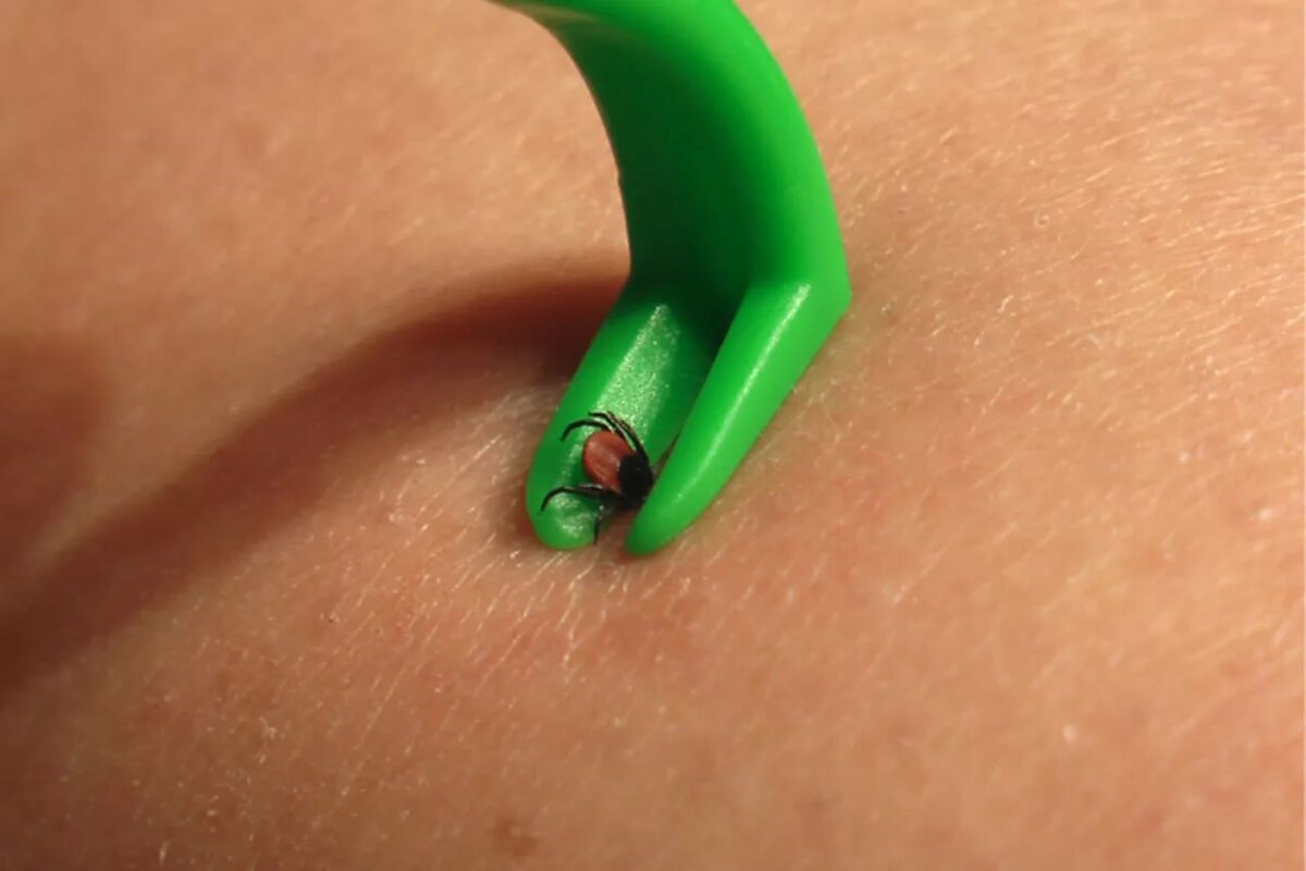 В больнице зафиксировано 103 случая укусов клещами среди детей